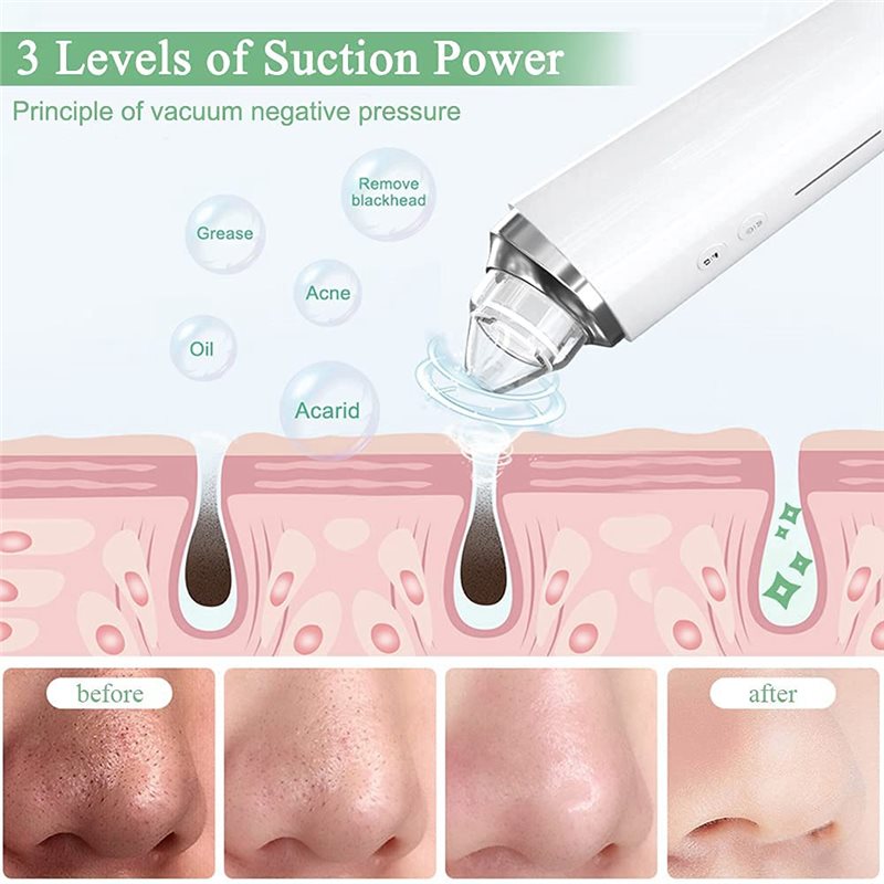 【FITTING】Kit de vácuo de poros - Pore Vacuum avaliação e preço