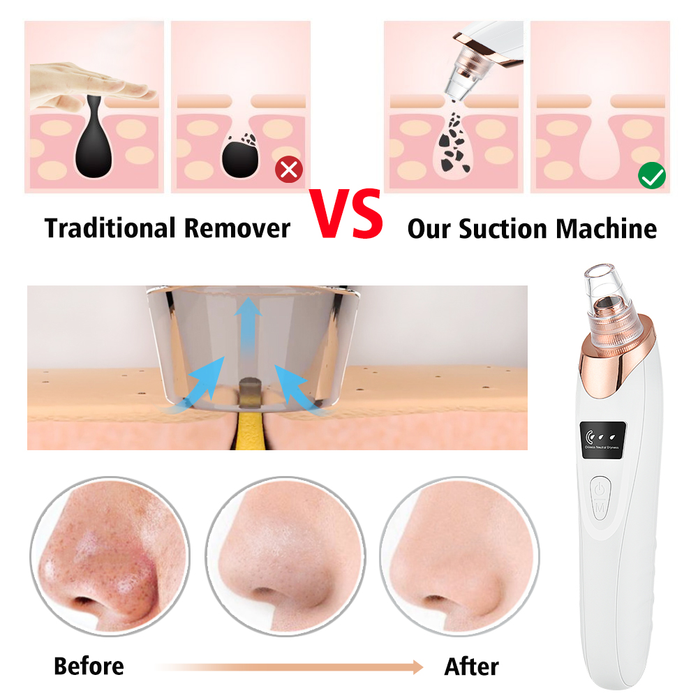 Removedor de cravo aspirador d - Pore Vacuum avaliação e preço